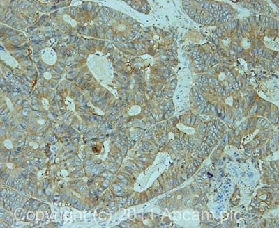 IHC image of ab70007 staining in human colon cancer formalin fixed paraffin embedded tissue section, performed on a Leica BondTM system using the standard protocol F. The section was pre-treated using heat mediated antigen retrieval with sodium citrate buffer (pH6, epitope retrieval solution 1) for 20 mins. The section was then incubated with ab70007, 5µg/ml, for 15 mins at room temperature and detected using an HRP conjugated compact polymer system. DAB was used as the chromogen. The section was then counterstained with haematoxylin and mounted with DPX.For other IHC staining systems (automated and non-automated) customers should optimize variable parameters such as antigen retrieval conditions, primary antibody concentration and antibody incubation times.