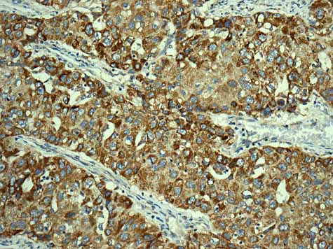 ab167160 showing +ve staining in Human lung adenocarcinoma.
