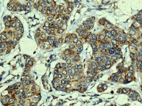 ab167160 showing +ve staining in Human breast carcinoma.