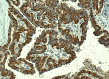 Immunohistochemical analysis of paraffin embedded Human thyroid gland papillary carcinoma tissue labeling TMPRSS3 with ab167160 at a 1/100 dilution.