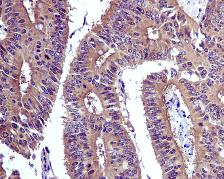 Immunohistochemical analysis of paraffin-embedded Human colon adenocarcinoma tissue labelling Silencer of Death Domain with ab134051 at 1/100 dilution.