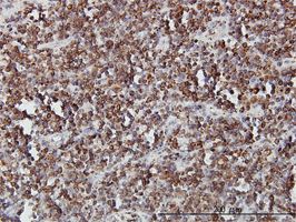 SLC44A2 antibody (ab57570) used in immunohistochemistry at 3ug/ml on formalin fixed and paraffin embedded human lymphoma.