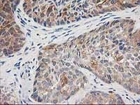 ab124027, at 1/150 dilution, staining TOMM34 in paraffin-embedded Human breast adenocarcinoma tissue by Immunohistochemistry.