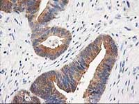 ab124027, at 1/150 dilution, staining TOMM34 in paraffin-embedded Human colon adenocarcinoma tissue by Immunohistochemistry.