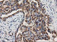ab124027, at 1/150 dilution, staining TOMM34 in paraffin-embedded Human lung carcinoma tissue by Immunohistochemistry.