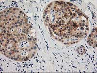 ab124027, at 1/150 dilution, staining TOMM34 in paraffin-embedded Human pancreas carcinoma tissue by Immunohistochemistry.