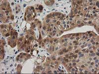 ab124027, at 1/150 dilution, staining TOMM34 in paraffin-embedded Human bladder carcinoma tissue by Immunohistochemistry.
