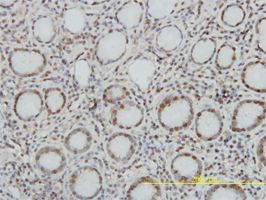 Topoisomerase I antibody (ab58313) used in immunohistochemistry at 5ug/ml on formalin fixed and paraffin embedded human hepatocellular carcinoma.