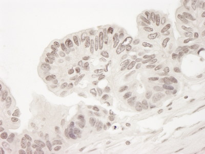 ab103528 at 1/250 staining Torc2 in Formalin-fixed paraffin-embedded section of Human ovarian carcinoma.