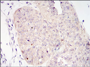 ab105932 at 1/200 dilution staining Torc2 in ovary tumour tissues by Immunohistochemistry Formalin-fixed, Paraffin-embedded tissue. Detection: DAB staining