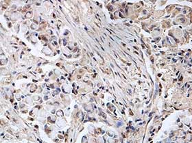 Immunohistochemical analysis of formalin-fixed, paraffin-embedded Human lung carcinoma tissue labelling TPA Tissue Plasminogen Activator with ab140088 at 1/100 dilution.