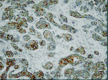 Ab14822 positively staining paraffin fixed human breast carcinoma tissue at 1/200, with overnight incubation at 4oC and enzymatic detection using DAB.