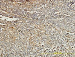 TPM4 antibody (ab58332) used in immunohistochemistry at 2ug/ml on formalin fixed and paraffin embedded human transitional cell carcinoma tissue.