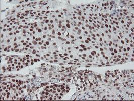 ab128112, at a 1/150 dilution, staining TPRKB in paraffin-embedded Human bladder carcinoma tissue by immunohistochemistry.