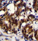 Immunohistochemical analysis of formalin-fixed, paraffin-embedded Human breast cancer tissue labeling TRADD with ab170371 at a 1/50 dilution followed by peroxidase conjugation of the secondary antibody and DAB staining.