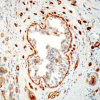 ab2386 staining human breat carcinoma by iHC-P.