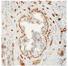Cell membrane and cytoplasmic staining of tumor and endothelial cells in formalin-fixed, paraffin-embedded human breast carcinoma using ab74256, with a peroxidase-conjugated secondry antibody and a DAB chromogen.