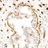 ab54445 staining Transglutaminase 2 in human breast carcinoma tissue by immunohistochemistry using formalin fixed, paraffin embedded section.