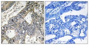 Immunohistochemistry analysis of paraffin-embedded Human colon carcinoma tissue, using 1/50 ab111951. The picture on the right is treated with the synthesized peptide.