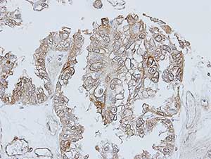 Immunohistochemical analysis of paraffin-embedded Human OVCA xenograft tissue labeling TRH Receptor with ab151510 at 1/00 dilution.