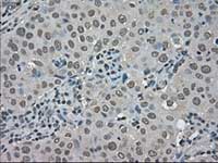 ab117981, at 1/50 dilution, staining TRIB2 in paraffin-embedded Human breast adenocarcinoma tissue by Immunohistochemistry.