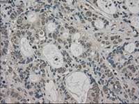 ab117981, at 1/50 dilution, staining TRIB2 in paraffin-embedded Human colon adenocarcinoma tissue by Immunohistochemistry.