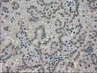 ab117981, at 1/50 dilution, staining TRIB2 in paraffin-embedded Human kidney carcinoma tissue by Immunohistochemistry.