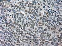 ab117981, at 1/50 dilution, staining TRIB2 in paraffin-embedded Human ovary adenocarcinoma tissue by Immunohistochemistry.