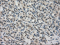 ab117981, at 1/50 dilution, staining TRIB2 in paraffin-embedded Human thyroid carcinoma tissue by Immunohistochemistry.