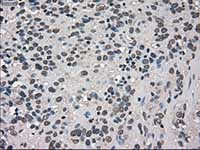 ab117981, at 1/50 dilution, staining TRIB2 in paraffin-embedded Human bladder carcinoma tissue by Immunohistochemistry.