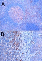 Ab4389 (1ug/ml) staining human RNF88 in human tonsil by Immunohistochemistry using paraffin embedded tissue. Microwaved antigen retrieval with citrate buffer pH 6, HRP-staining.A) positive cells next to a secondary follicleB) positive cells below tonsillar epithelium.In paraffin embedded Human Tonsil, ab4389 stains a group of cells in the interfollicular area, below the epithelium of tonsillar criptae and weak in germinal centre.