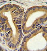 Immunohistochemical analysis of formalin-fixed, paraffin-embedded Human prostate carcinoma tissue labeling TRIM65 with ab170424 at 1/10 dilution followed by peroxidase-conjugated secondary antibody and DAB staining.