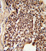 Immunohistochemical analysis of formalin-fixed, paraffin-embedded Human prostate carcinoma labelling Triosephosphate isomerase with ab135532 at 1/50 dilution, followed by a peroxidase-conjugated secondary antibody and DAB staining.