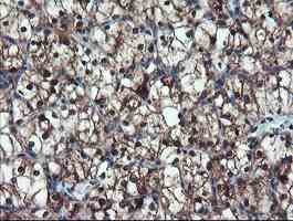 ab128109, at a dilution of 1/150, staining TRIP in paraffin-embedded Human kidney carcinoma tissue by Immunohistochemistry.