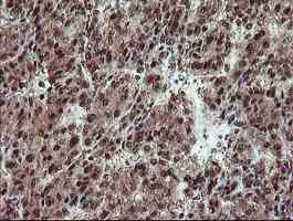 ab128109, at a dilution of 1/150, staining TRIP in paraffin-embedded Human liver carcinoma tissue by Immunohistochemistry.