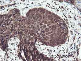 ab128109, at a dilution of 1/150, staining TRIP in paraffin-embedded Human lung carcinoma tissue by Immunohistochemistry.