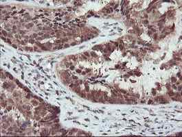 ab128109, at a dilution of 1/150, staining TRIP in paraffin-embedded Human ovary adenocarcinoma tissue by Immunohistochemistry.
