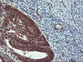 ab128109, at a dilution of 1/150, staining TRIP in paraffin-embedded Human endometrium adenocarcinoma tissue by Immunohistochemistry.