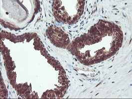 ab128109, at a dilution of 1/150, staining TRIP in paraffin-embedded Human prostate carcinoma tissue by Immunohistochemistry.