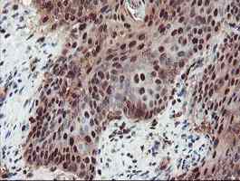 ab128109, at a dilution of 1/150, staining TRIP in paraffin-embedded Human bladder carcinoma tissue by Immunohistochemistry.