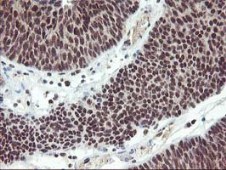 ab119779, at 1/150 dilution, staining Tristetraprolin in paraffin-embedded Human bladder carcinoma tissue by Immunohistochemistry.