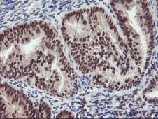 ab119779, at 1/150 dilution, staining Tristetraprolin in paraffin-embedded Human endometrium adenocarcinoma tissue by Immunohistochemistry.