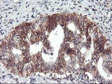 ab119779, at 1/150 dilution, staining Tristetraprolin in paraffin-embedded Human pancreas carcinoma tissue by Immunohistochemistry.