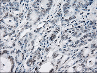 ab124024, at 1/50, staining Tristetraprolin in paraffin embedded Human colon adenocarcinoma tissue by Immunohistochemistry.