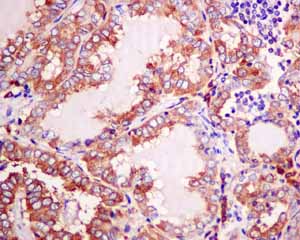 Immunohistochemical analysis of paraffin embedded Human Thyroid gland carcinoma tissue using ab150428 showing +ve staining.