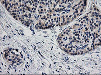 ab124034, at 1/50 dilution, staining Tropomodulin 1 in paraffin-embedded Human pancreas carcinoma tissue by Immunohistochemistry.