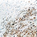 Human malignant melanoma: IHC-P staining for tyrosinase-related protein-1 using ab49684. Cytoplasmic staining of tumor cells.