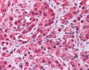 ab3243  staining TRPM8 in human prostate cancer tissue section by Immunohistochemistry (Formalin/PFA fixed paraffin-embedded sections). 