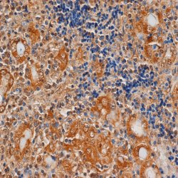 ab27974 staining TSH Receptor in Human thyroid tissue by Immunohistochemistry (Formalin/PFA-fixed paraffin-embedded sections).