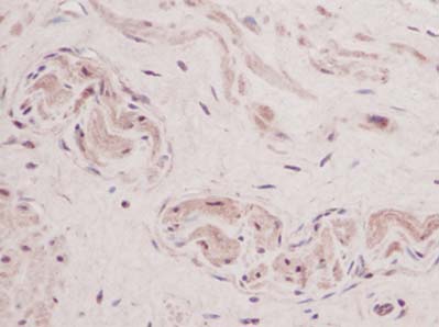 ab47943  staining TSLP in human prostate tissue section by Immunohistochemistry (Formalin-PFA fixed paraffin-embedded sections). Tissue underwent heat mediated antigen retrieval in sodium citrate buffer (pH 6.0). The primary antibody was used at 0.125 ug/ml and incubated with sample at 4°C overnight. A HRP-labeled polymer detection system was used with a DAB chromogen. 